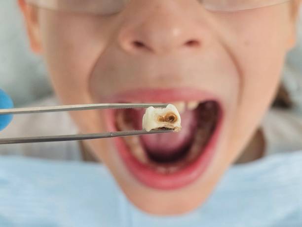 Best Emergency Tooth Extraction in Lakemont, PA